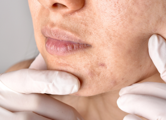 Verstopte poriën (clogged pores): Begrijpen, voorkomen en doeltreffend aanpakken